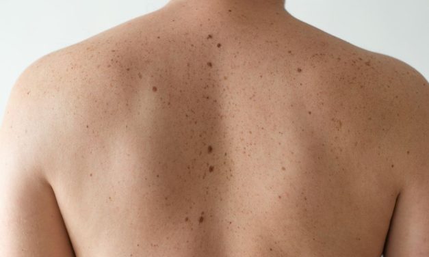 Madeži – ukras na koži ili znak potencijalne opasnosti?