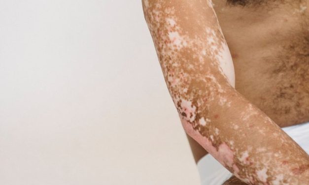 Psorijeza – Kako stati na kraj ovoj kožnoj bolesti?