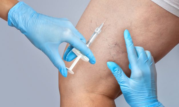 KAPILARE NA NOGAMA – uzroci, simptomi i liječenje