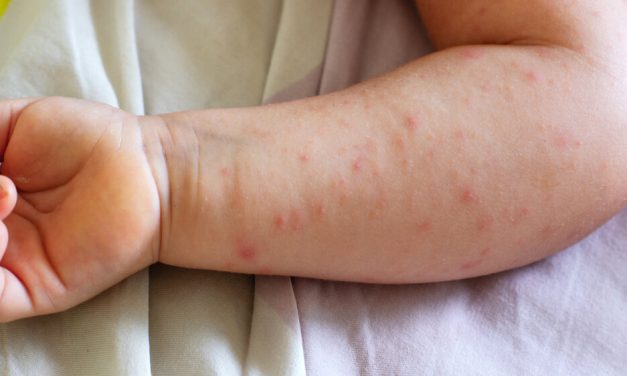 Porastao broj zaraženih malim boginjama: Na snazi pooštrene mere epidemiološkog nadzora