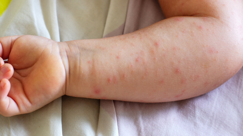 Porastao broj zaraženih malim boginjama: Na snazi pooštrene mere epidemiološkog nadzora