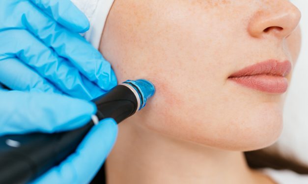 Šta je mikroneedling? Povijest tretmana i njegova popularnost u estetskoj dermatologiji