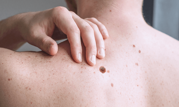 Prepoznavanje melanoma