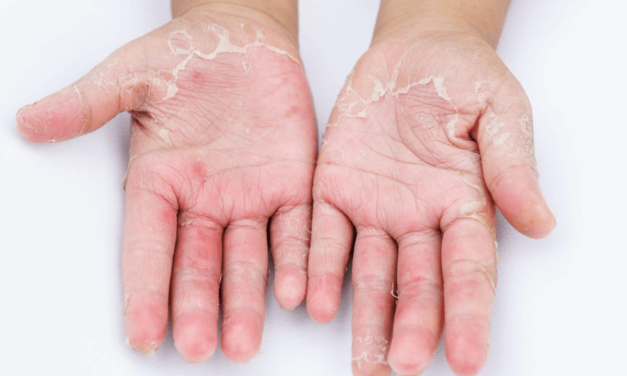 Lečenje kontaktnog dermatitisa