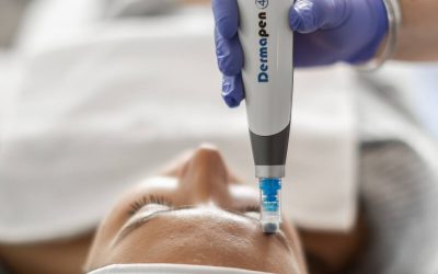Zašto microneedling postaje standard u modernoj nezi kože