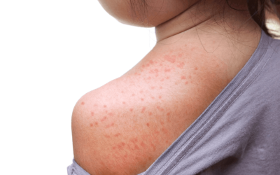 Sitan osip, crvenilo i svrbež kod djece: najčešći uzroci