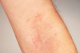 Atopijski dermatitis – šta je to i kako se leči?