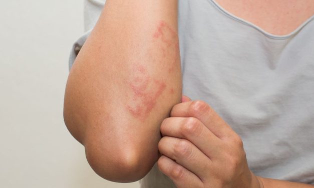 12 vrsta crvenih tačkica na koži: Šta mogu biti uzroci njihovih pojava i kako se leče