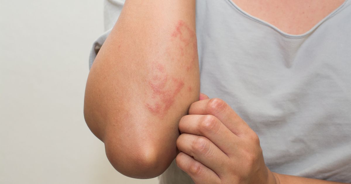 12 vrsta crvenih tačkica na koži: Šta mogu biti uzroci njihovih pojava i kako se leče