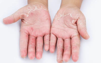 Lečenje kontaktnog dermatitisa