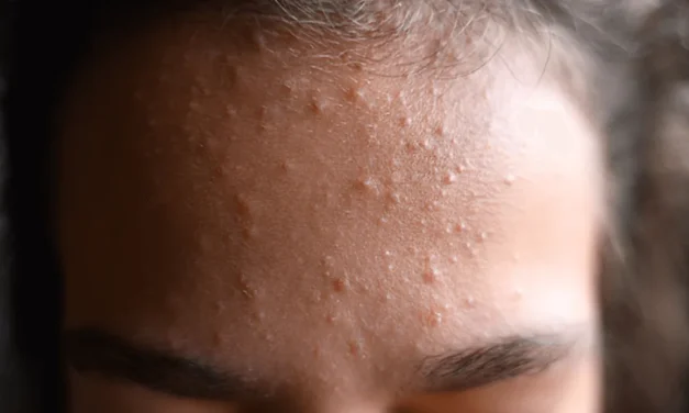 Najčešće greške u nezi koje pogoršavaju komedone na licu