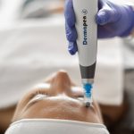 Zašto microneedling postaje standard u modernoj nezi kože