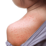 Sitan osip, crvenilo i svrbež kod djece: najčešći uzroci